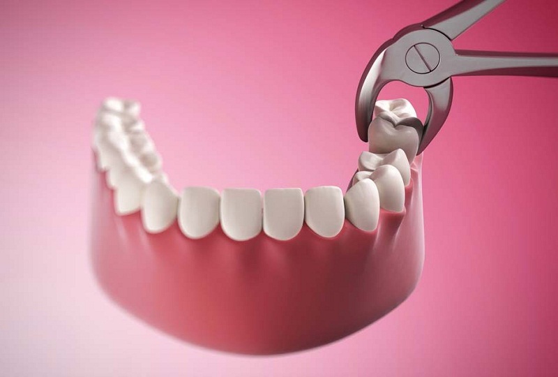Nhổ răng khôn giúp khắc phục triệt để lợi trùm răng khôn