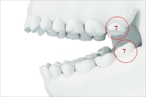Mất răng số 7 sẽ ảnh hưởng không nhỏ đến sức khỏe răng miệng