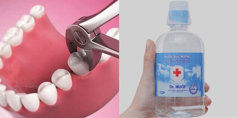 Hãy súc miệng bằng nước muối sinh lý để giảm đau, chống viêm sưng