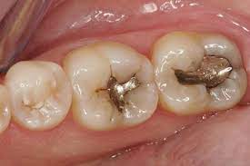 Răng hàm sâu có nên nhổ không ?