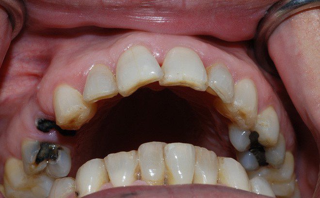 Các giai đoạn sâu răng hàm