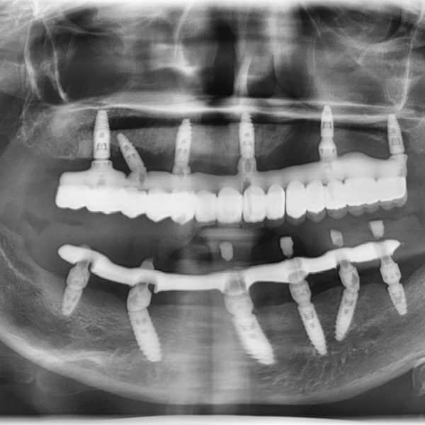 Hình ảnh X Ray Implant