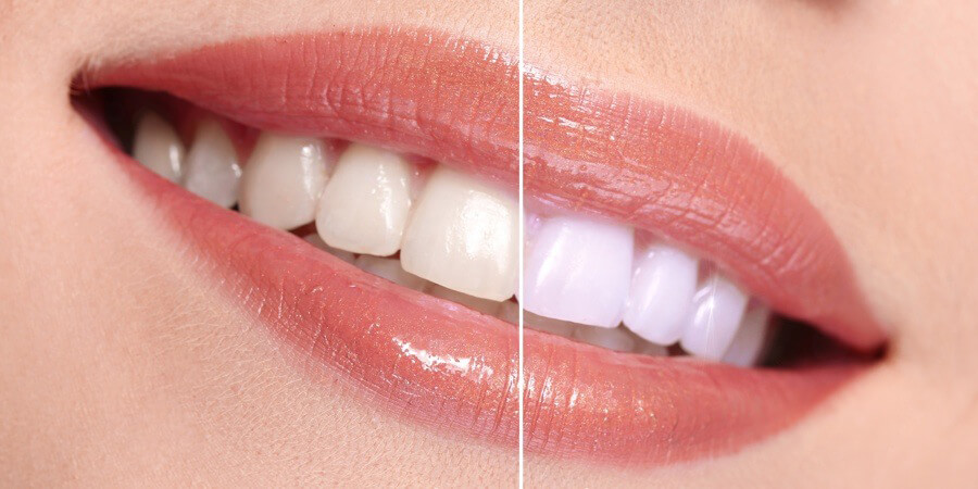 platinum-Teeth-Whitening-5