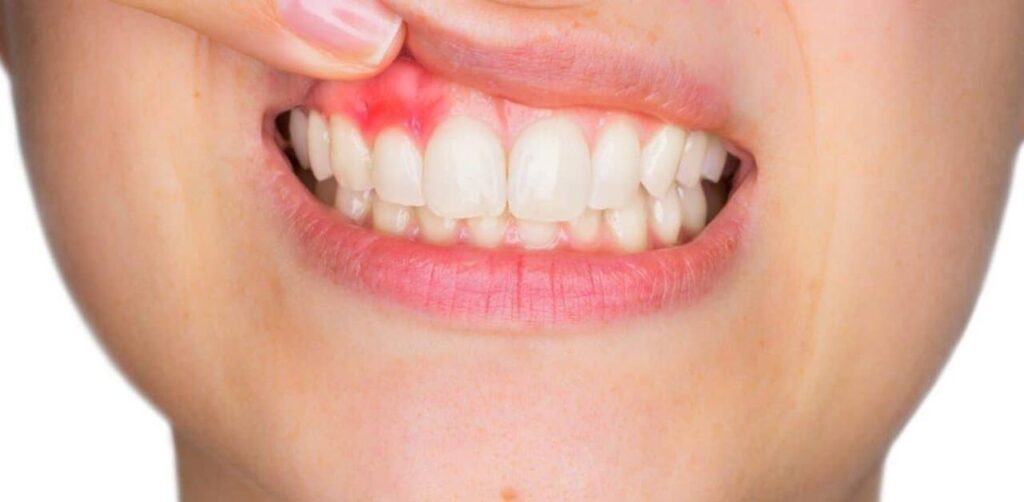 Áp xe răng chính là biến chứng của nhiễm trùng
