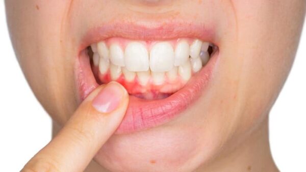 Ngứa chân răng, đau rát,.. dấu hiệu của vấn đề sức khỏe răng miệng cần phải điều trị
