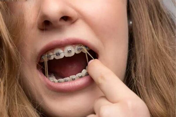 Dây niềng răng bị ố vàng có nghiêm trọng không?