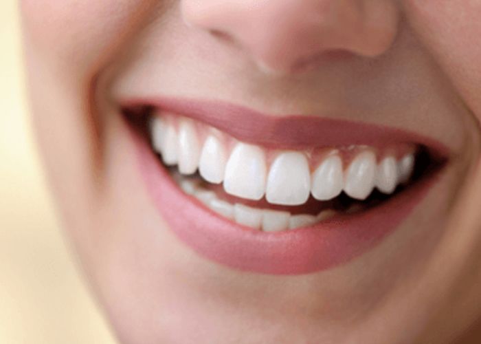 Một hàm răng đẹp giúp bạn có được tự tin