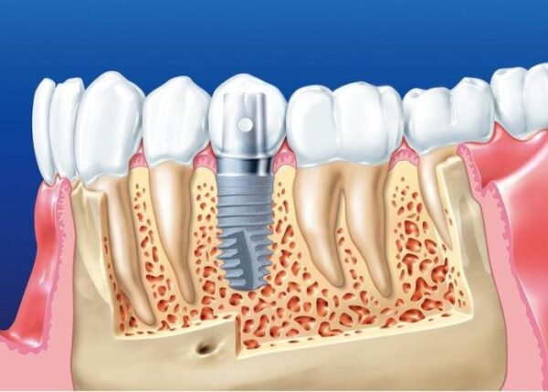 Cần phải vệ sinh kỹ càng khi implant răng