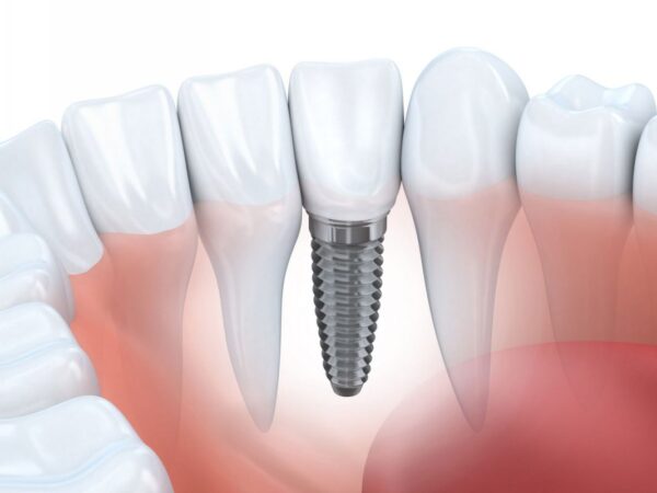 Nhược điểm của trồng răng implant-Bảo hiểm không chi trả
