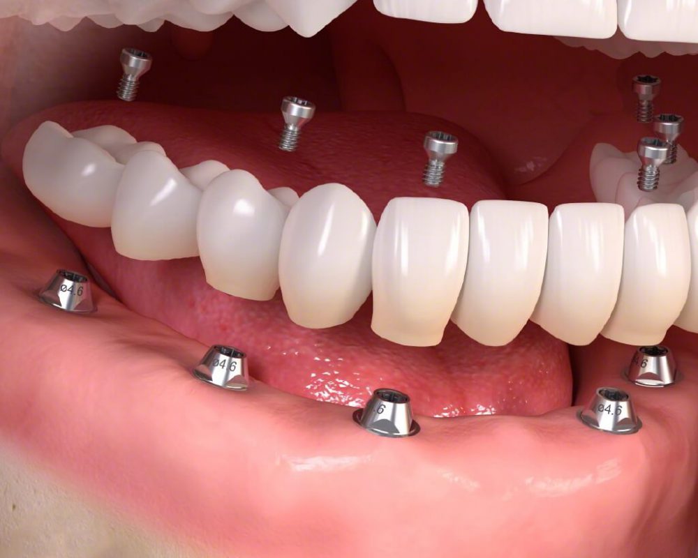 Đôi nét khái quát về trồng răng implant