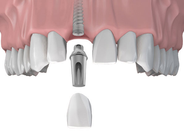 Implant răng cửa có đau không?