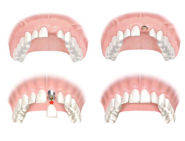 Implant răng cửa là gì? Những vấn đề liên quan đến trồng implant răng cửa