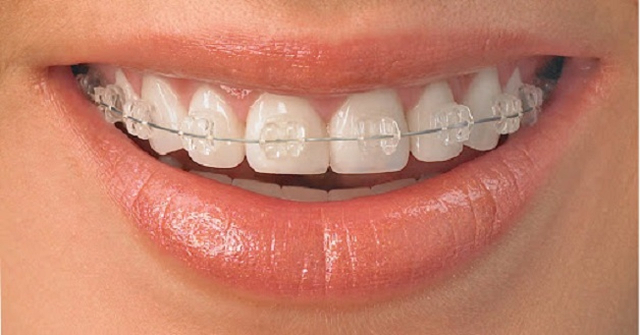 Định nghĩa về niềng răng mắc cài pha lê 