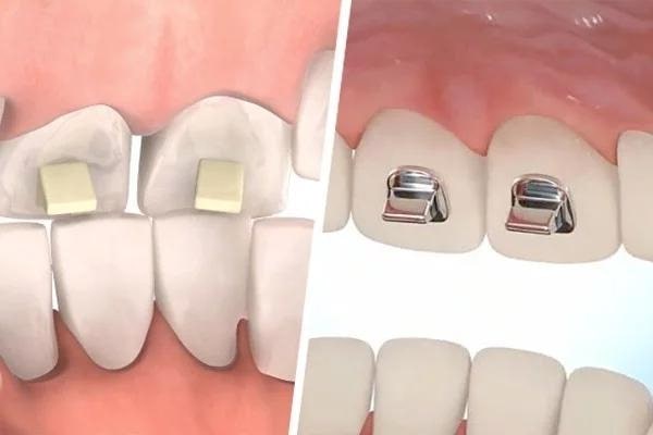 Những lý do nên nâng khớp cắn trong niềng răng