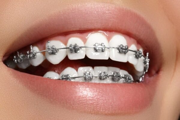 Quy trình nâng khớp cắn trong niềng răng