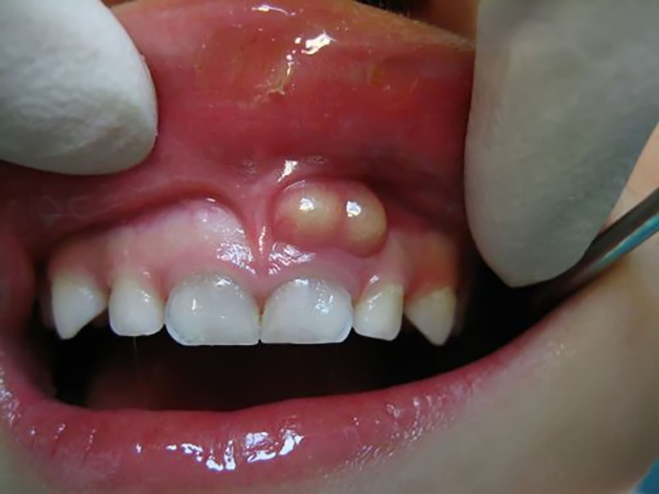 Biến chứng có thể xảy ra bởi viêm chân răng có mủ