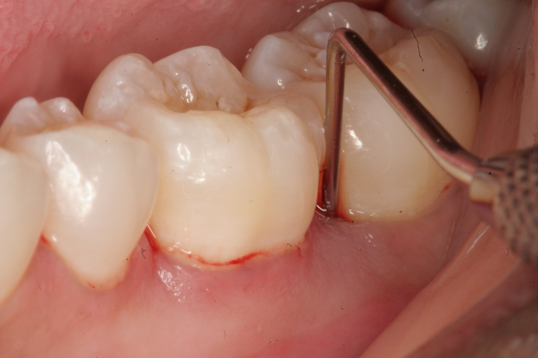 Dấu hiệu để người bệnh nhận biết bị viêm chân răng