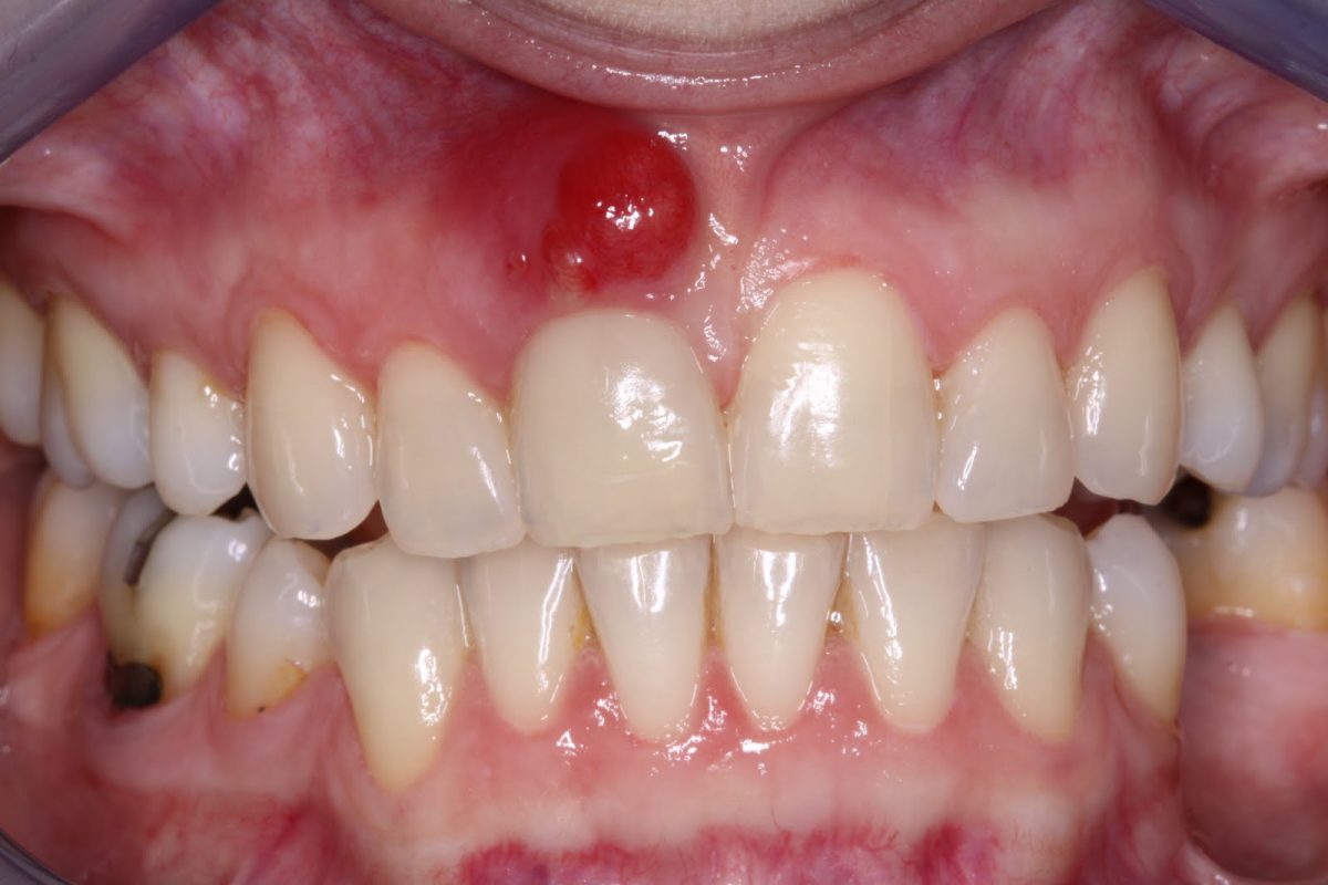 Một số nguyên nhân gây viêm chân răng có mủ