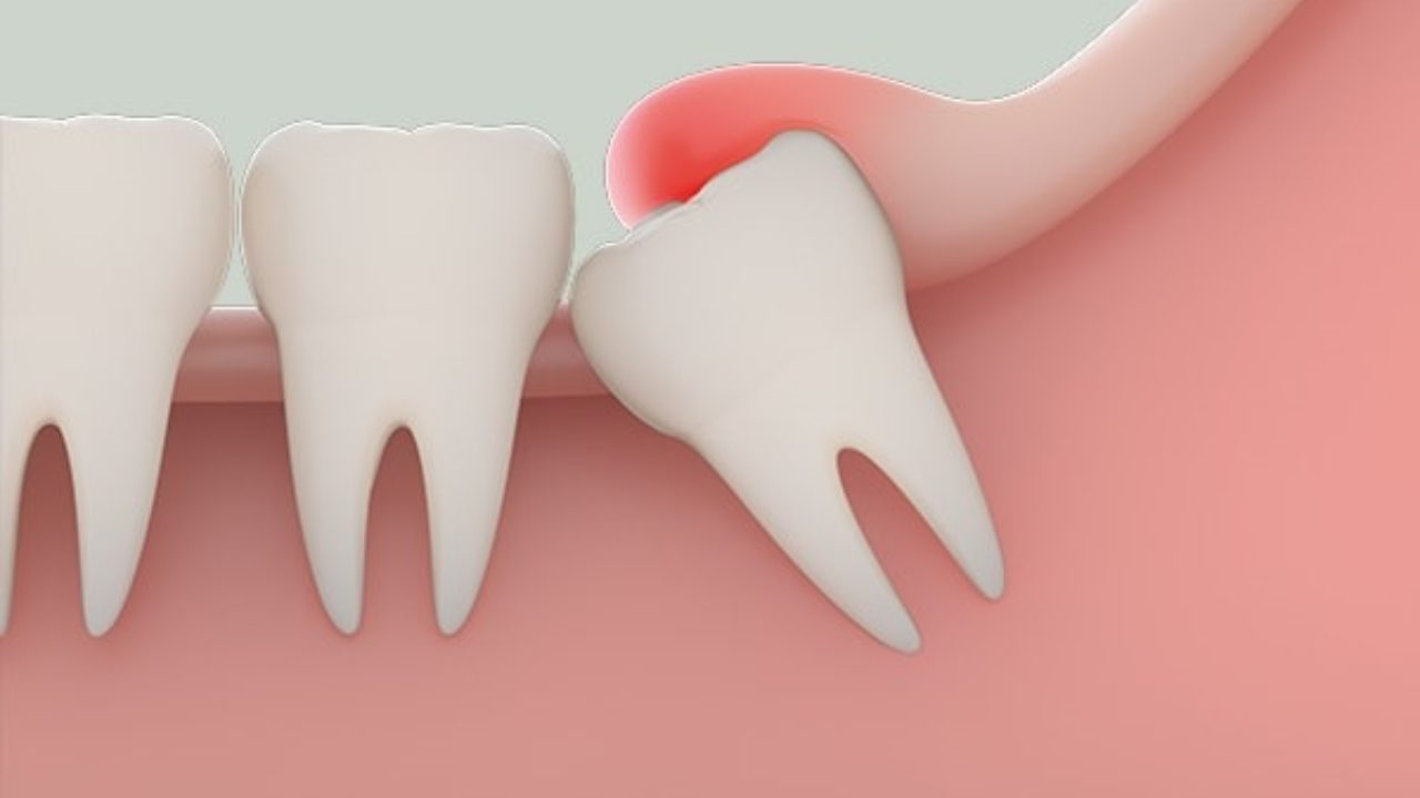 Phương pháp trị giảm sưng nướu răng khôn 