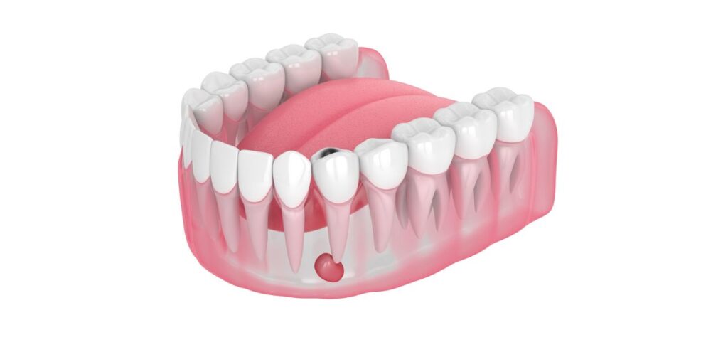 Viêm chân răng là gì?