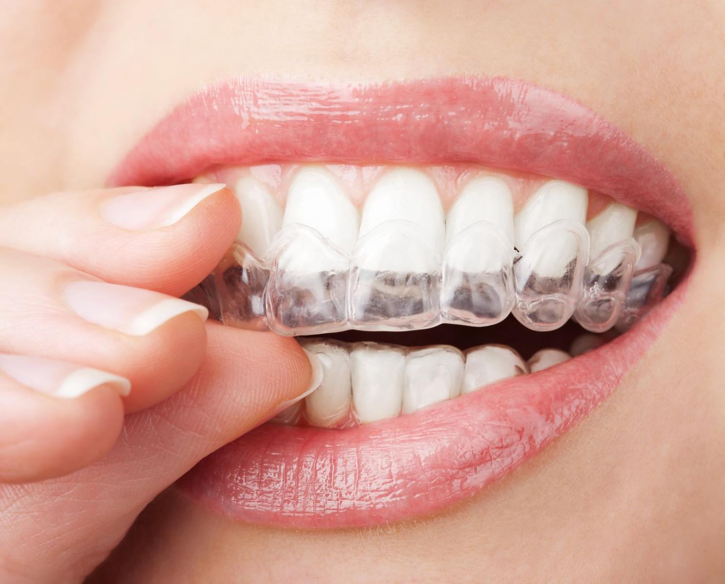 Định nghĩa niềng răng trong suốt là gì?
