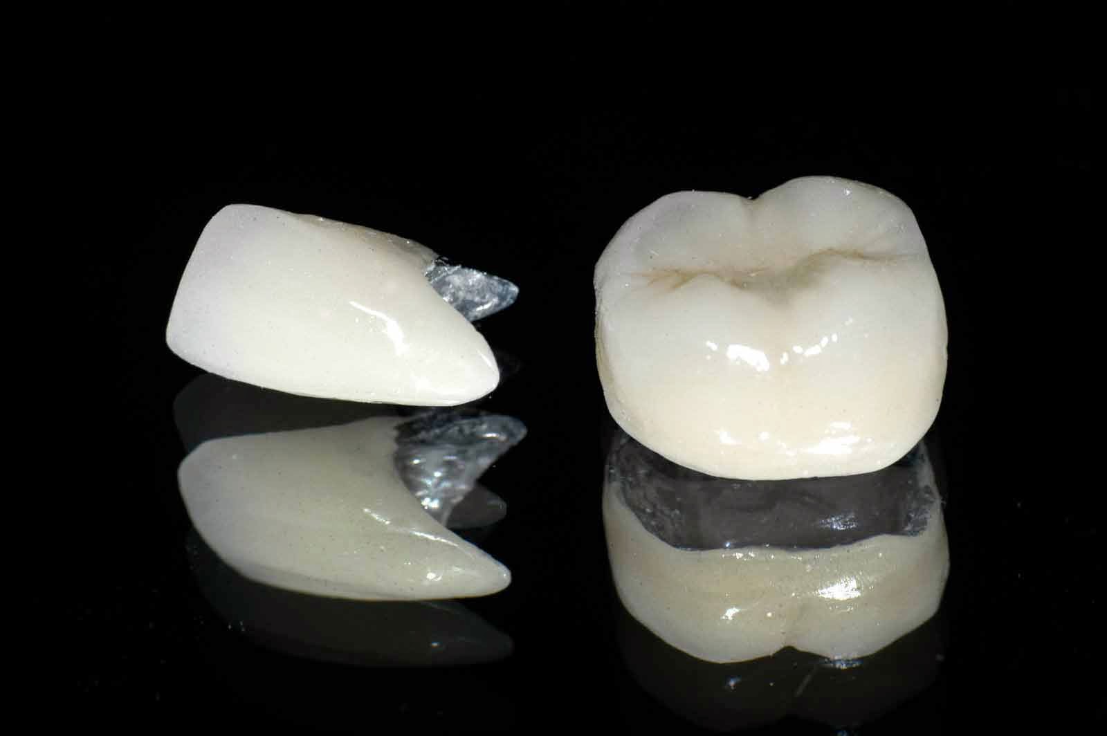 Răng sứ làm từ kim loại có tốt không?