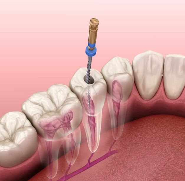 Quá trình hút tủy răng có đau không?