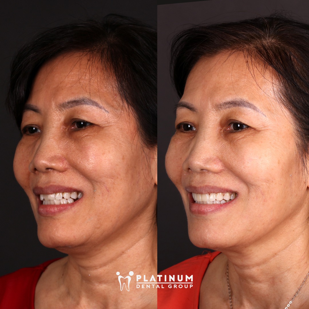 Hình ảnh trước và sau 10 tháng điều trị tại Platinum Dental Group