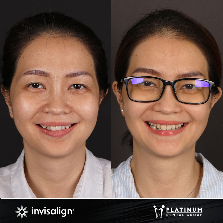 Hình ảnh Khách Hàng trước và sau khi niềng răng trong suốt Invisalign