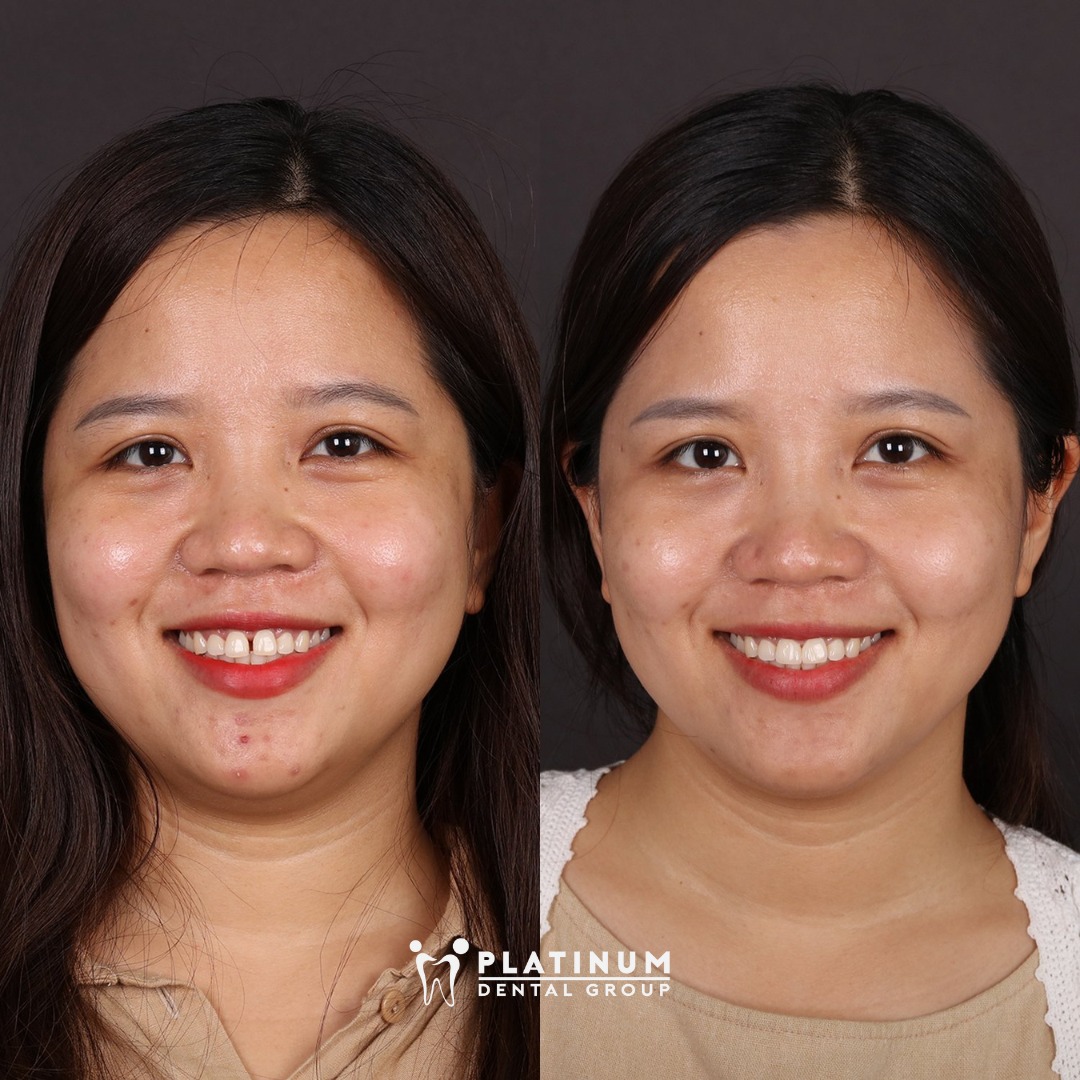 Hình ảnh trước và sau khi dán sứ Veneer tại Platinum Dental