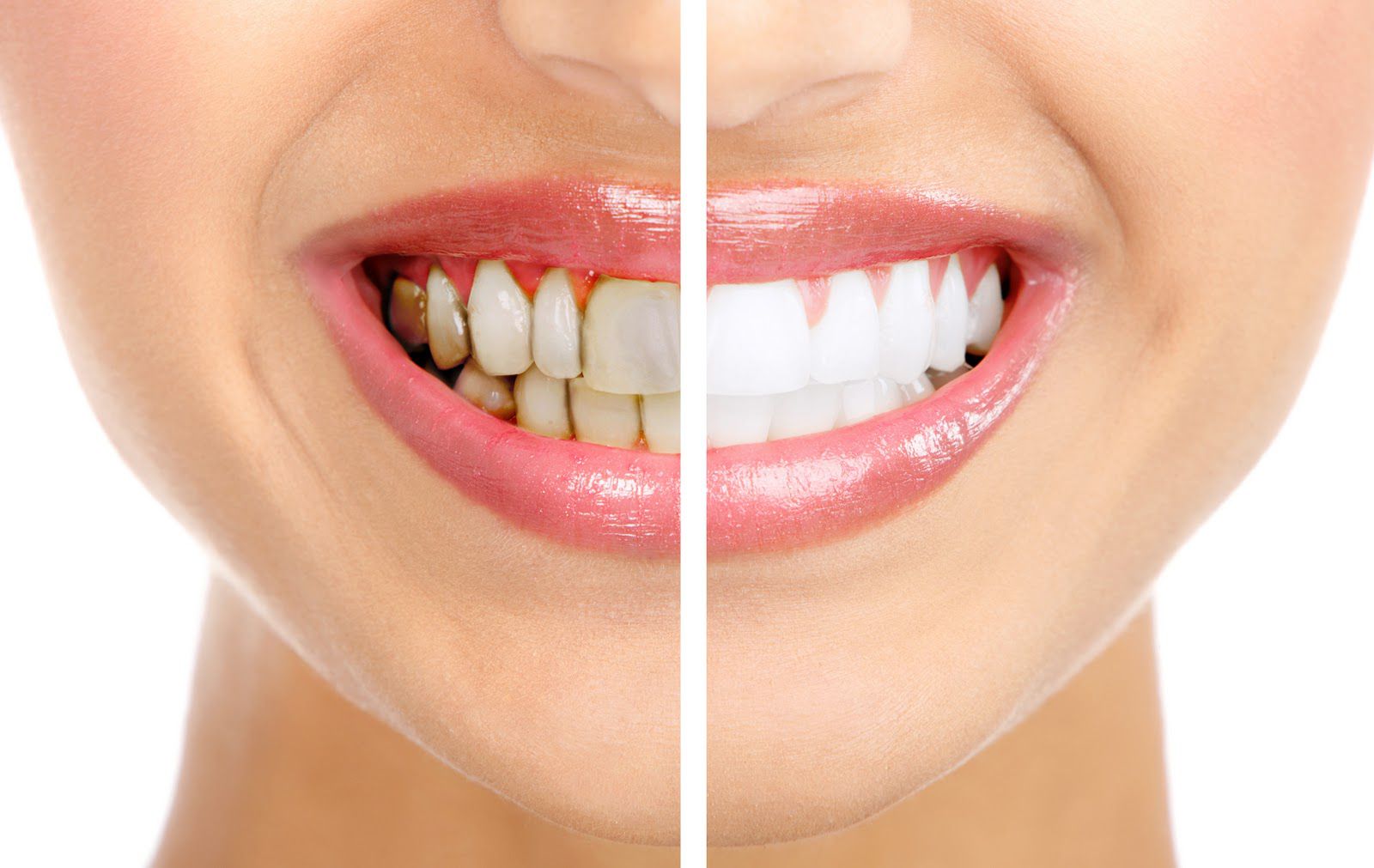 Khi nào nên mài răng bọc sứ?