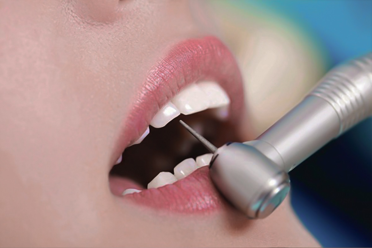 Mài răng bọc sứ có gây ảnh hưởng đến răng?