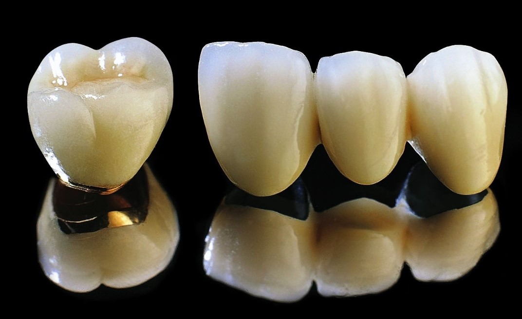 Răng sứ Titan