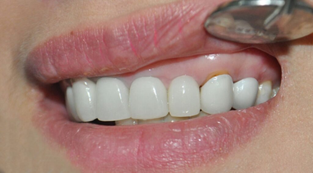 Dấu hiệu răng sứ bị hở phổ biến nhất