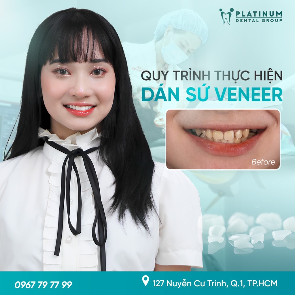 Quy trình thực hiện dán sứ Veneer tại Platinum Dental