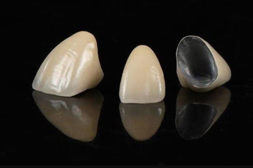 Răng sứ kim loại có nguy cơ đen viền nướu cao