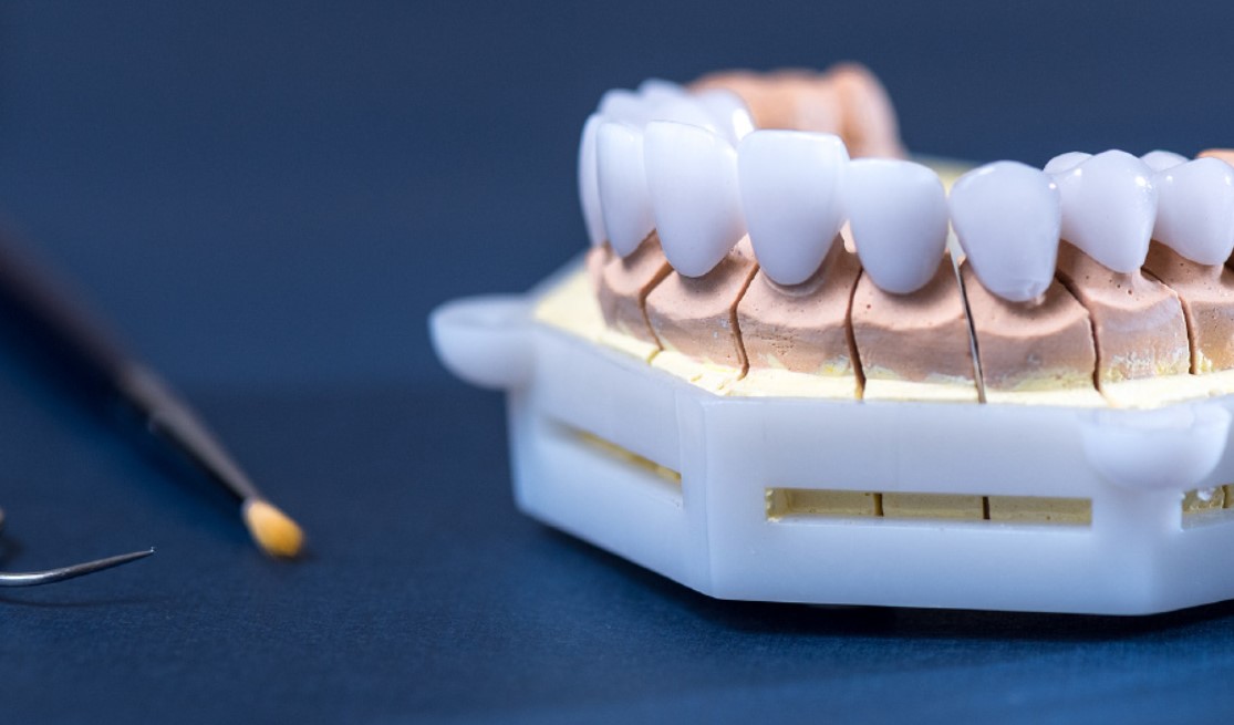 Khi nào nên chọn răng sứ kim loại hoặc răng toàn sứ?