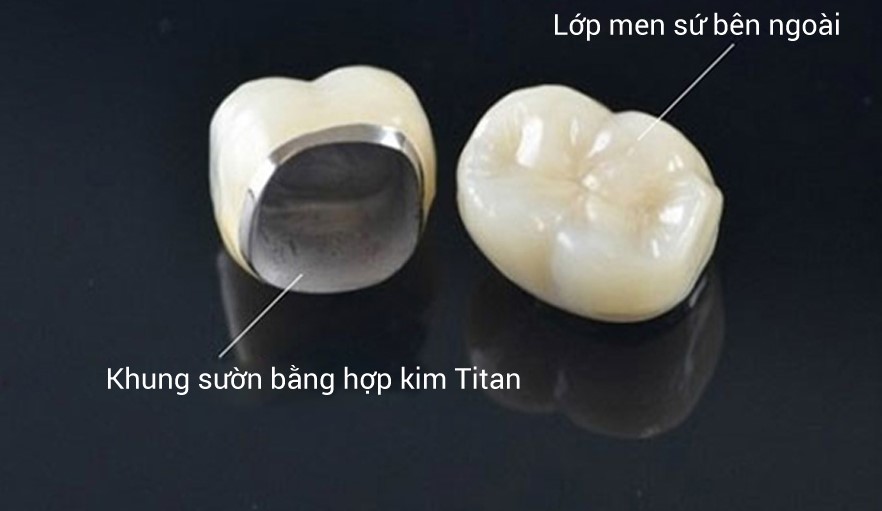 Răng sứ Titan và răng toàn sứ có gì khác nhau?
