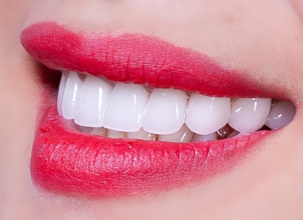 Răng sứ Lava có tốt không?