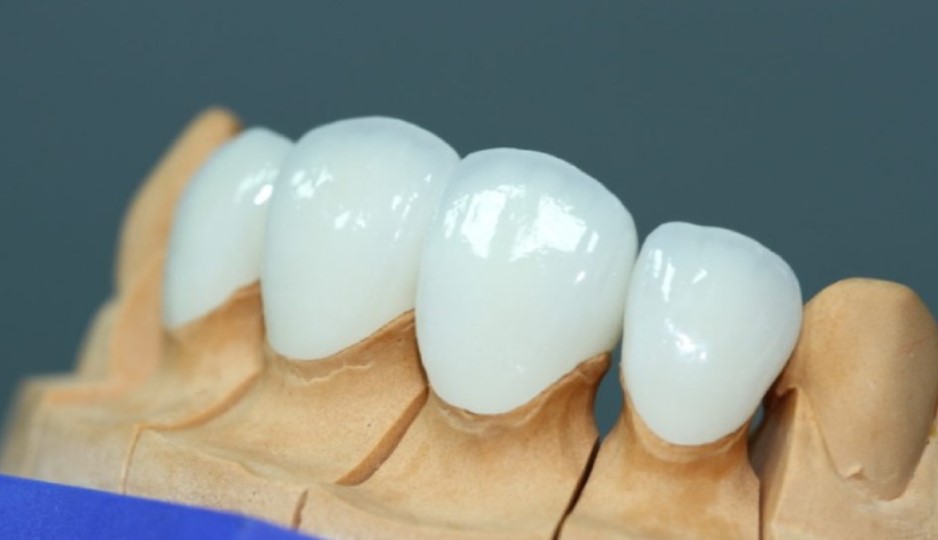 Răng sứ Lava Esthetic Fluorescent Full-Contour Zirconia